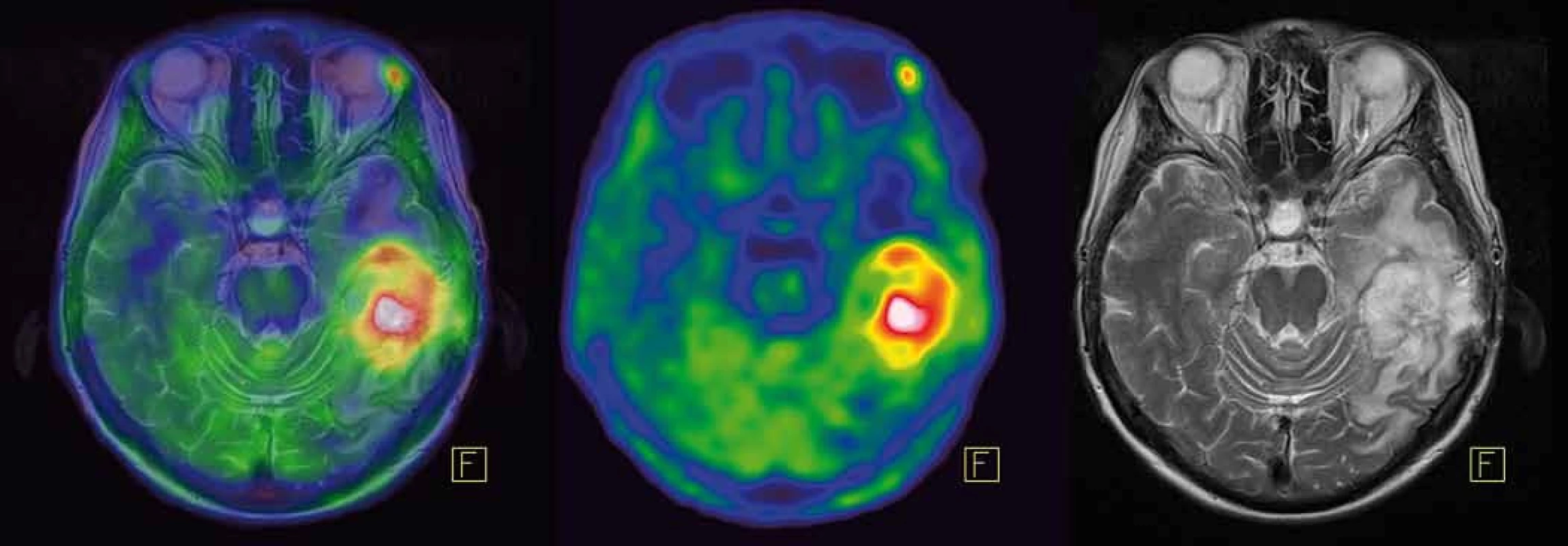 [&lt;sup&gt;11&lt;/sup&gt;C]methionin-PET a fúze s MRI mozku.
Recidiva gliomu temporálně vlevo vykazuje vysokou akumulaci [&lt;sup&gt;11&lt;/sup&gt;C]methioninu.