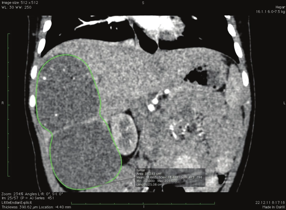 Výpočet objemu tumoru v koronárnej rovine, softvér OsiriX, pacient č. 1
Fig. 5: Tumor volume calculation in coronary plane, software OsiriX, patient No. 1