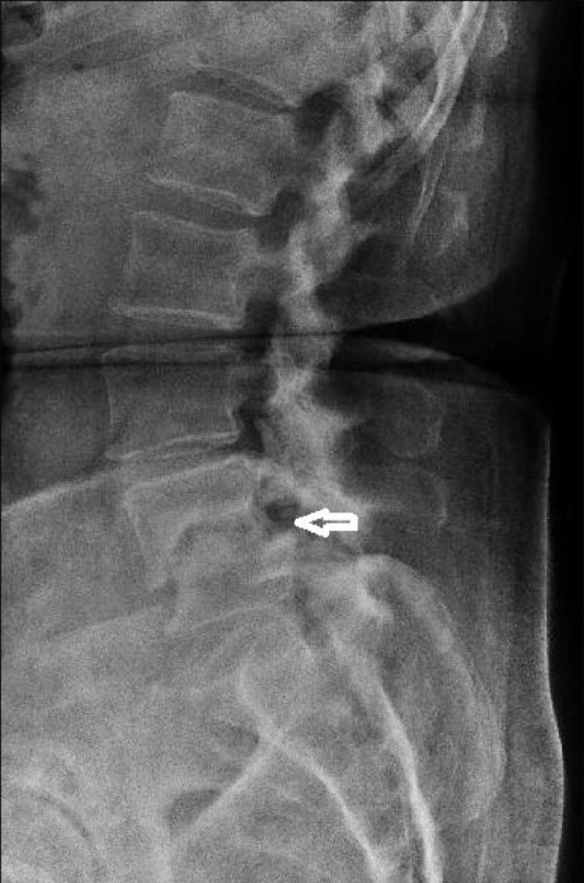 Prostý rentgenový snímek bederní páteře po prodělané spondylodiscitidě