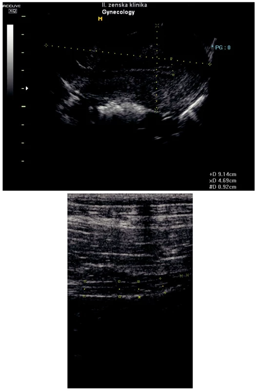 a) USG uteru v I. trimestri gravidity, 
b) USG apendixu bez zápalových zmien v I. trimestri gravidity
Pic. 3 a) USG of the womb in the first trimester of gravidity,
b) USG of the appendix without inflammatory changes in the first trimester of gestation