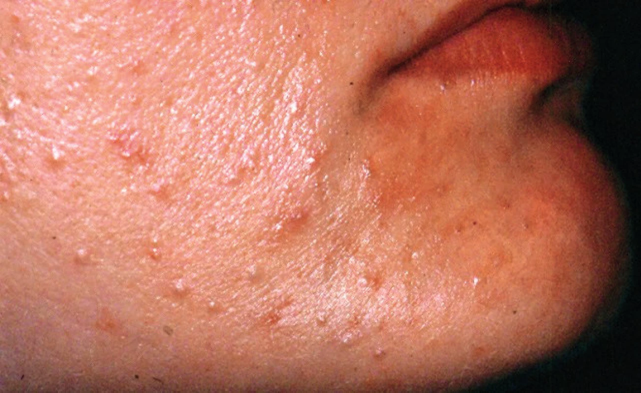 Papulózne eflorescencie na koži tváre a retikulárna forma na korešpondujúcej tvárovej sliznici (Ďurovič)