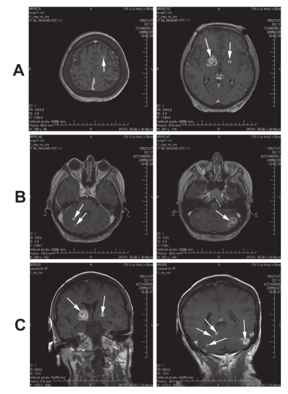 MR nález vícečetných supratentoriálních (A) a infratentoriálních (B) ložiskových změn (šipky) na TIWI v rovině transverzální (A, B) a koronární (C) po podání kontrastní látky. Stav před stereotaktickou biopsií a následnou léčbou mozkové toxoplazmózy.