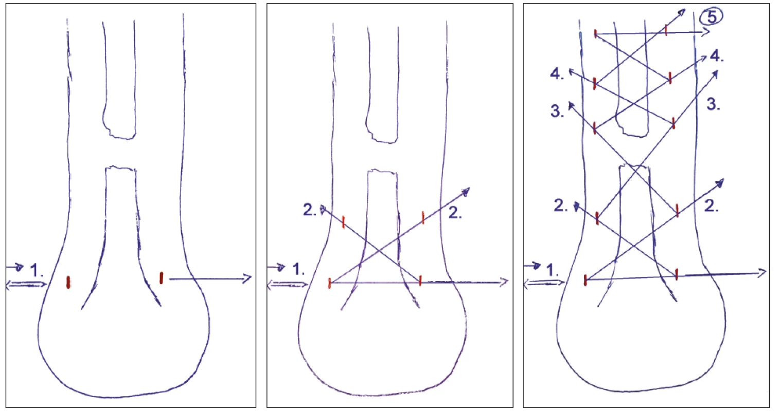 Perkutánní technika – a) - zavedení drátu s vlákny do distálního pahýlu šlachy, b) „zig-zag“ metoda zakládání vláken, c) konečný stav