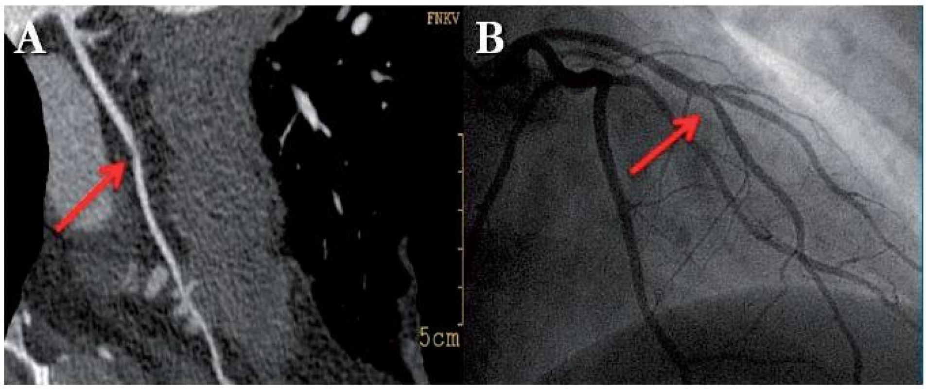 Padesátidvouletá nemocná vyšetřena pro bolesti na hrudi, kalciové skóre 0. CT koronarografie prokázala měkký plát v středním úseku ramus interventricularis anterior (RIA) (A). Invazivní koronarografie nález potvrdila (B), pacientce byla provedena PCI s implantací stentu.
