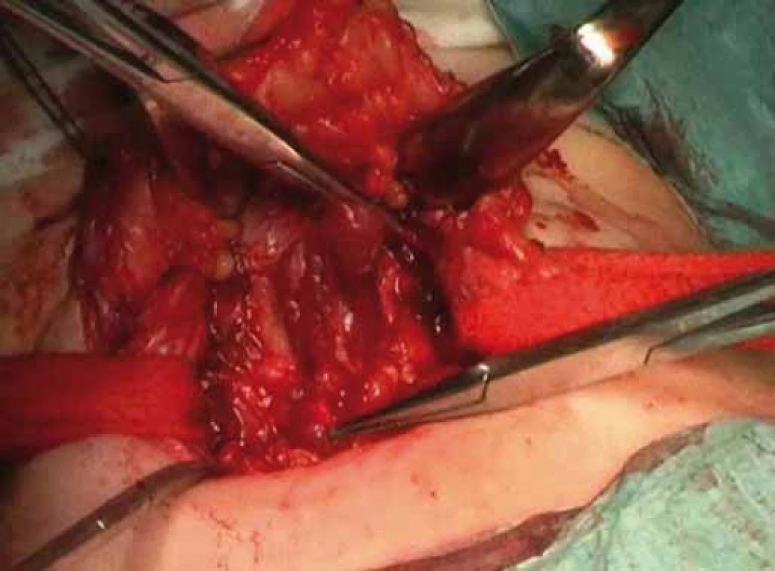 Completion of thyroidectomy.