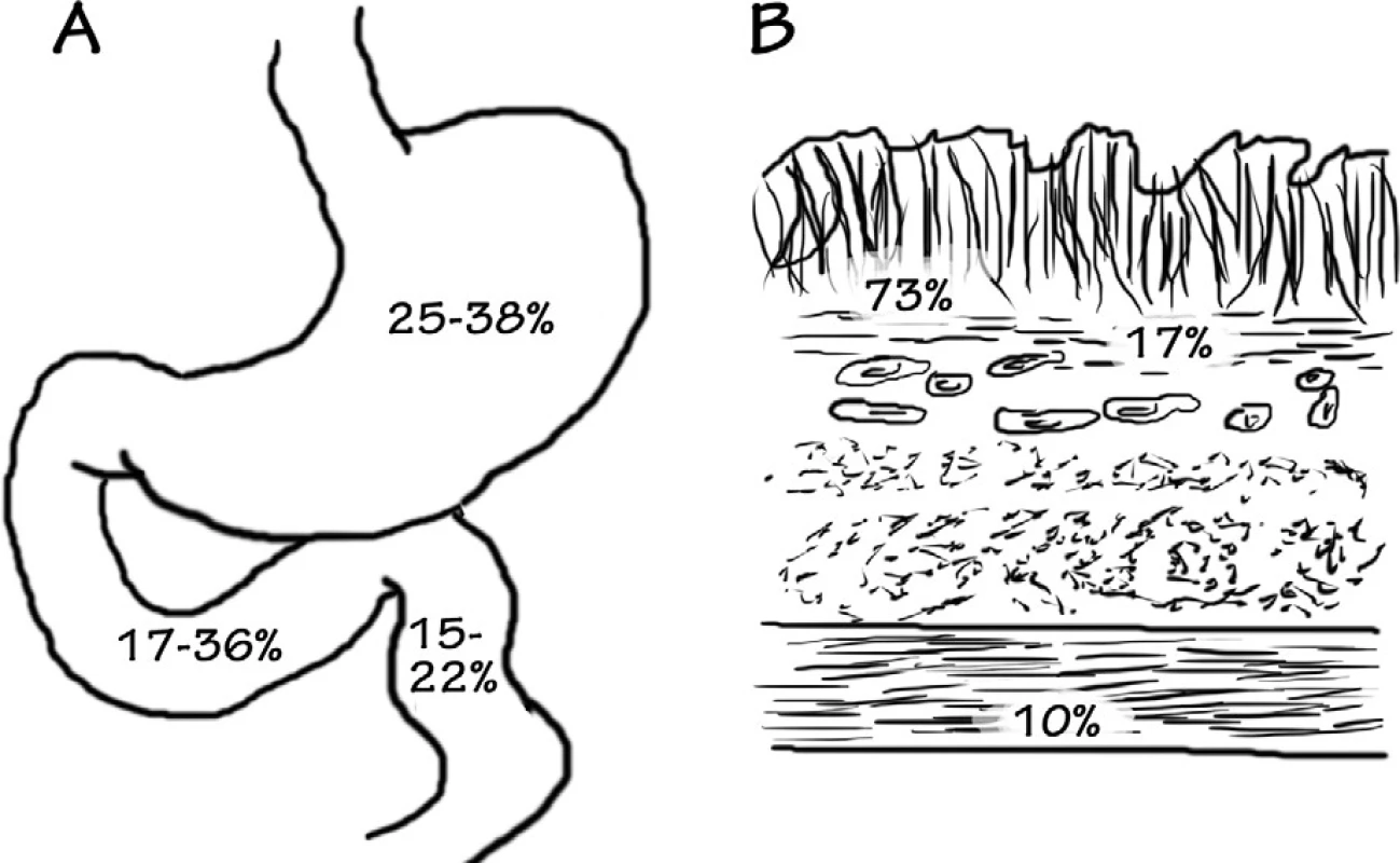 Najčastejšia lokalizácia heterotopického pankreasu (A – anatomická lokalizácia – 25–38 % žalúdok, 17–36 % duodenum, 15–22 % jejunum; B – histologická lokalizácia – 73 % submukózne, 17 % – lamina muscularis propria, 10 % – subserózne) – podľa [9]
Obr. 1. The most common localization of heterotopic pancreas (A – anatomical localization – 25–38% stomach, 17–36% duodenum, 15–22% jejunum, B – histological localization – 73% submucous, 17% – lamina muscularis propria, 10% – subserous) – according to [9]