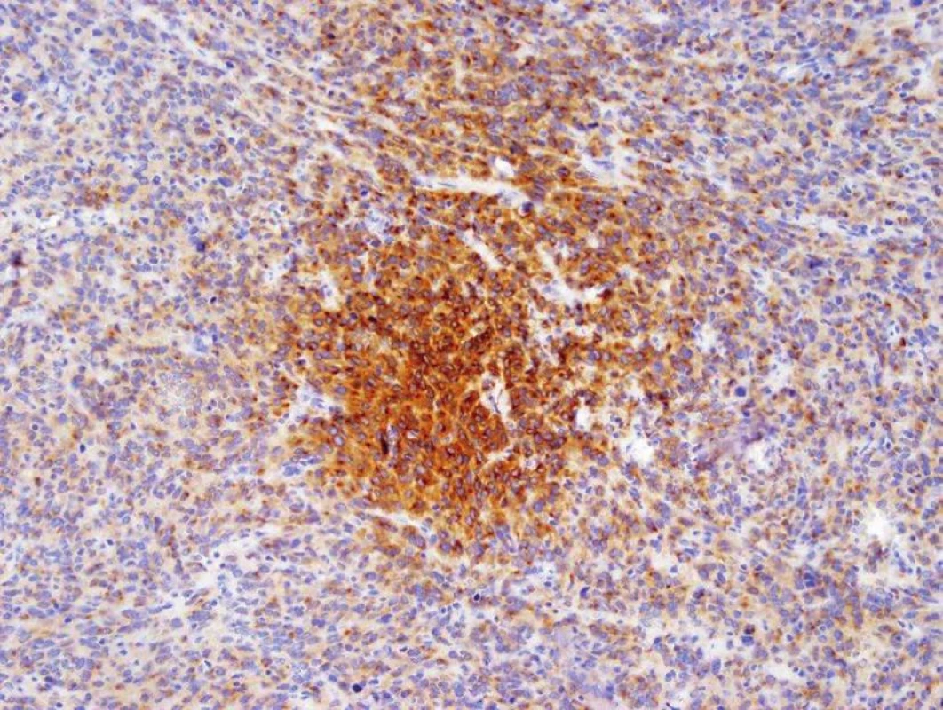 Recidiva tumoru − imunohistochemické vyšetření protilátkou CD117 – pozitivita (hnědé zbarvení) je jednoznačné kritérium diagnózy GIST
Fig. 10: Tumor reccurence − CD117 antibody immunohistochemistry − positivity (brown staining) is an unambiguous criterion for the diagnosis of GIST