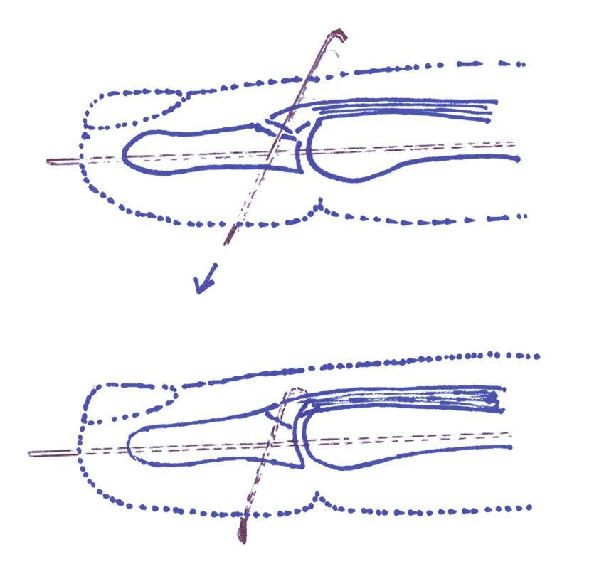 Technika podle Badii a Riana. Perkutánní fixace distálního článku v dorzální flexi. Následně je druhým K-drátem ohnutým do tvaru háčku perkutánně fixován odtržený fragment a palmárně zakrácen do úrovně kůže.
