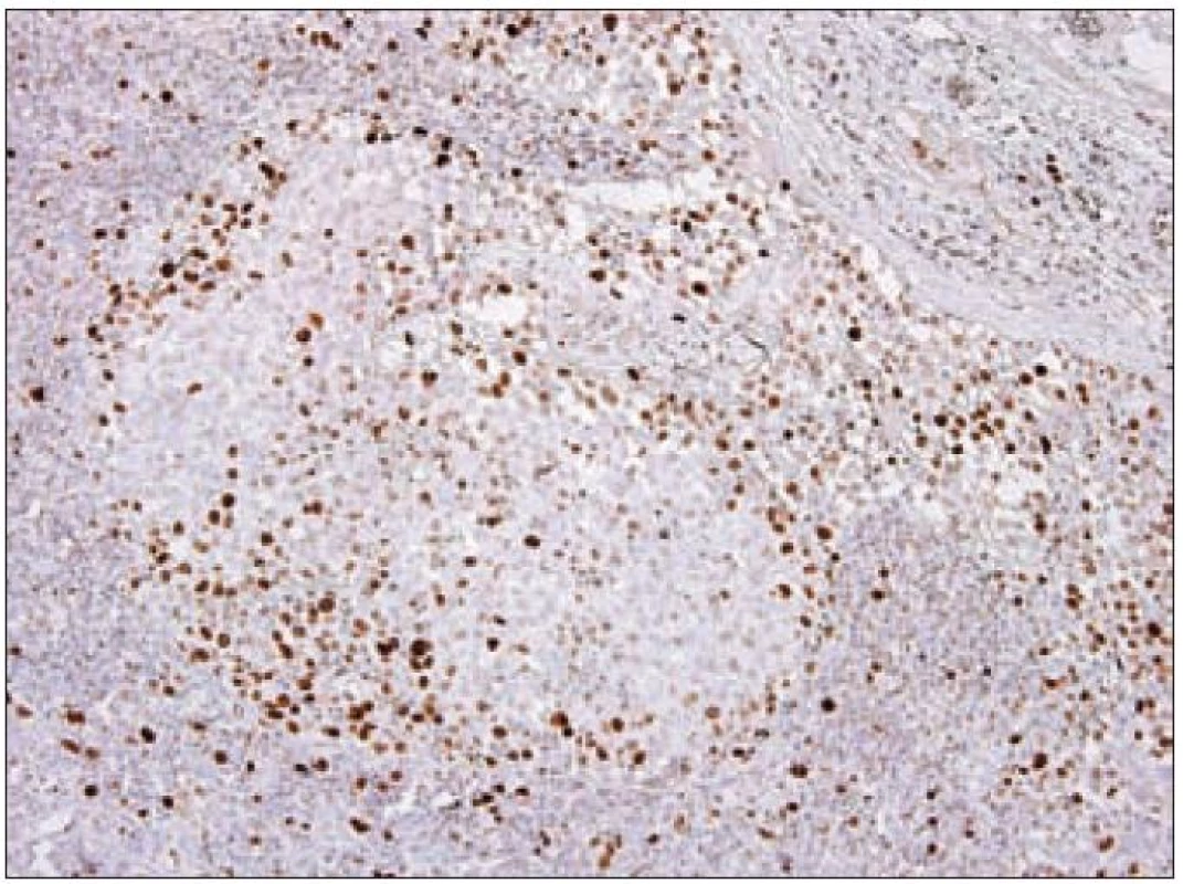 Antigen Ki-67 (MIB- 1) – imunohistochemické vyšetření. Jaderná pozitivita (hnědý precipitát) Langerhansových buněk v korovém splavu lymfatické uzliny při LCH, jádra dobarvena hematoxylinem.