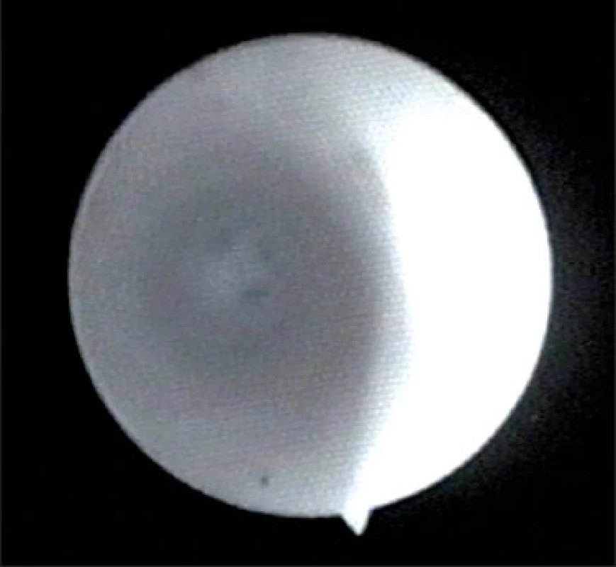 Angioskopický obraz – lumen bypassu výrazně zúžen do tří menších otvorů.