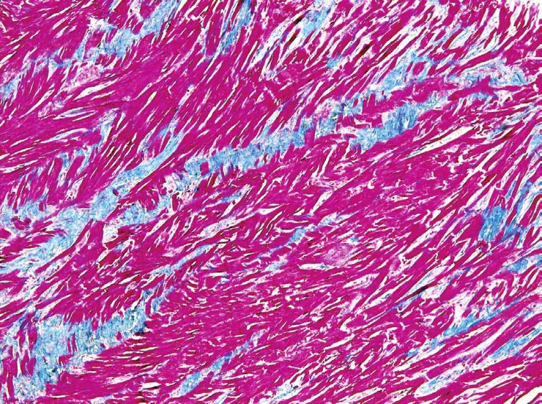 Pruhy vazivové tkáně mezi kardiomyocyty (modrý trichrom, 100x).