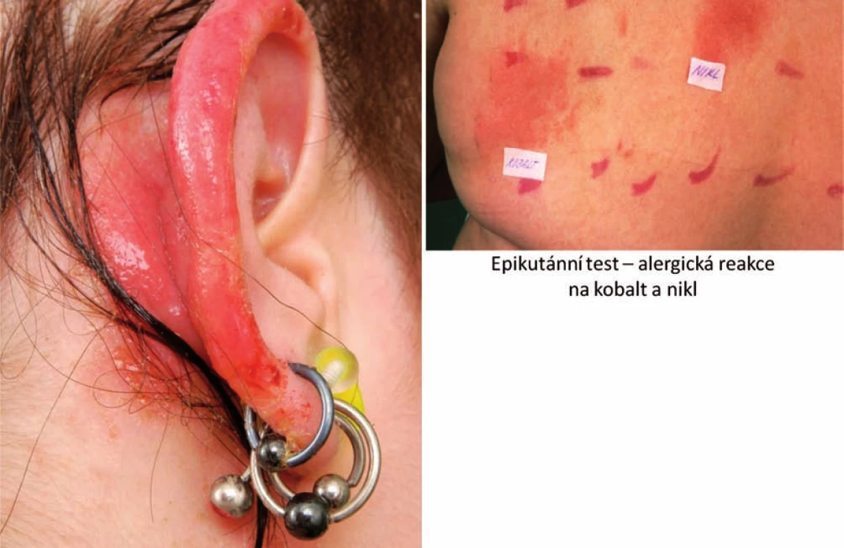 Eczema atopicum et contactum – kobalt, nikl