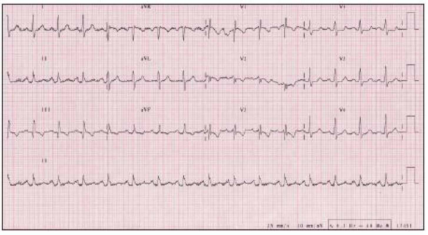 EKG z roku 2008, 4 mesiace po operácii, ustúpili známky preťaženia pravej komory srdca.