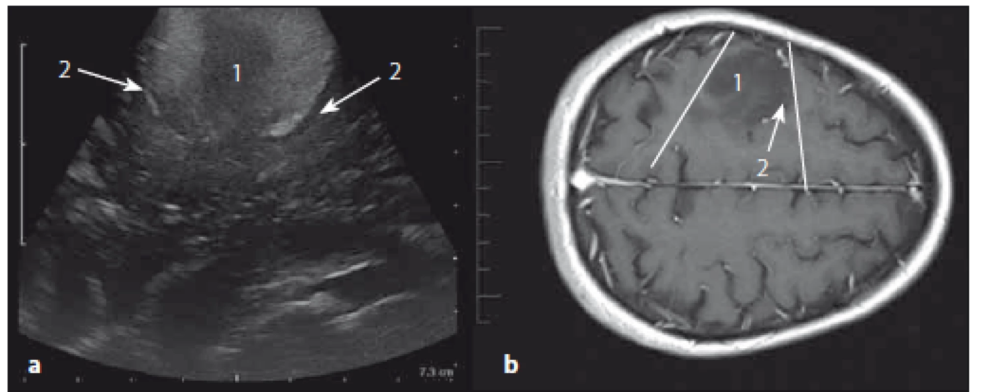 Astrocytom grade II frontálně vpravo – sonografický a MR T1W obraz.
Fig. 10. Low-grade astrocytoma (grade II) of the right frontal lobe – ultrasound and MRI T1W images.