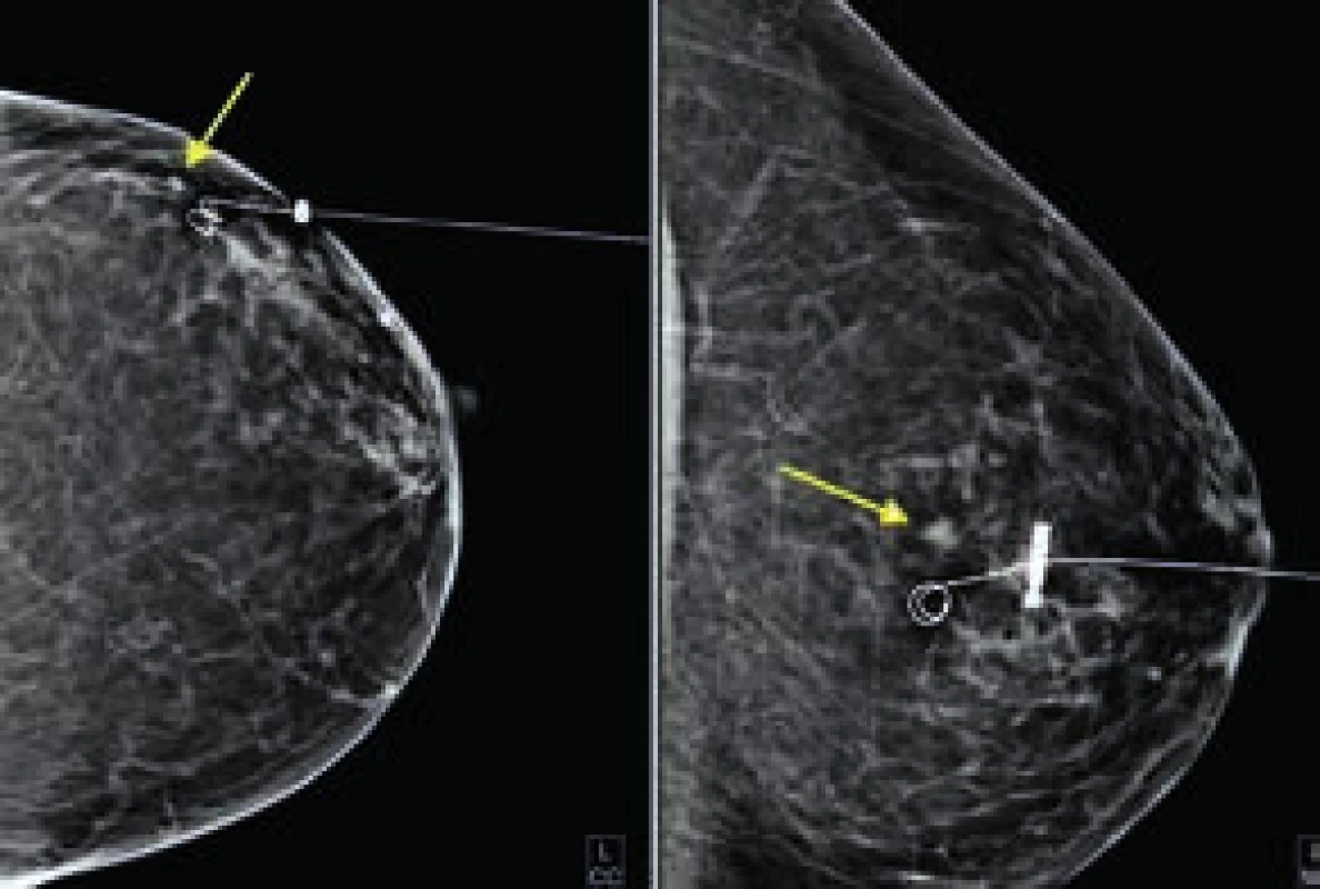 Mamogram s vodičem v CC a ML projekci.
Malý tumor označen šipkou