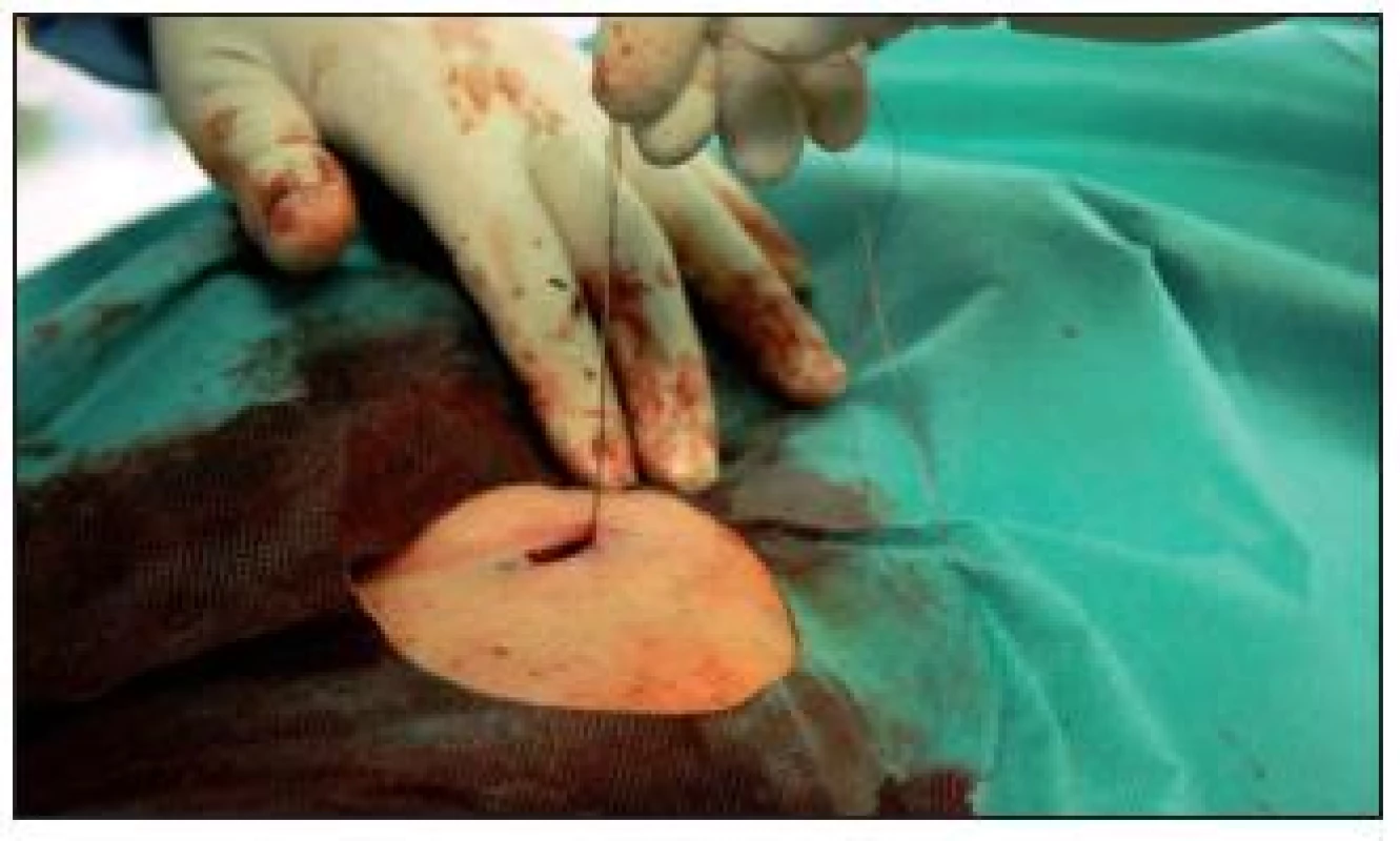 Katetrizačně provedená sutura femorální tepny po odstranění zaváděcího pouzdra, žádné krvácení, jizva 1 cm