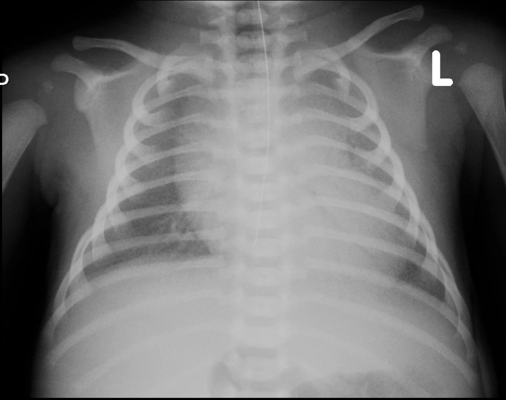 Rtg hrudníku – zahájení UPV, před podáním surfaktantu.
Fig. 1. Chest X-ray – 1st day of life, before surfactant administration.