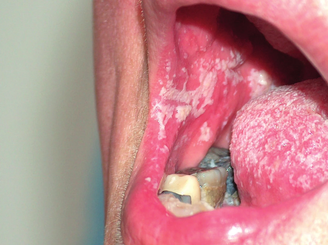 Soor – bělavé povlaky na bukální sliznici a jazyku