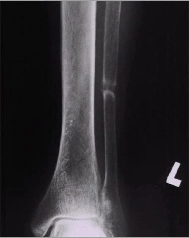 Obraz Looserovy pseudofraktury na fibule (známka osteomalácie).