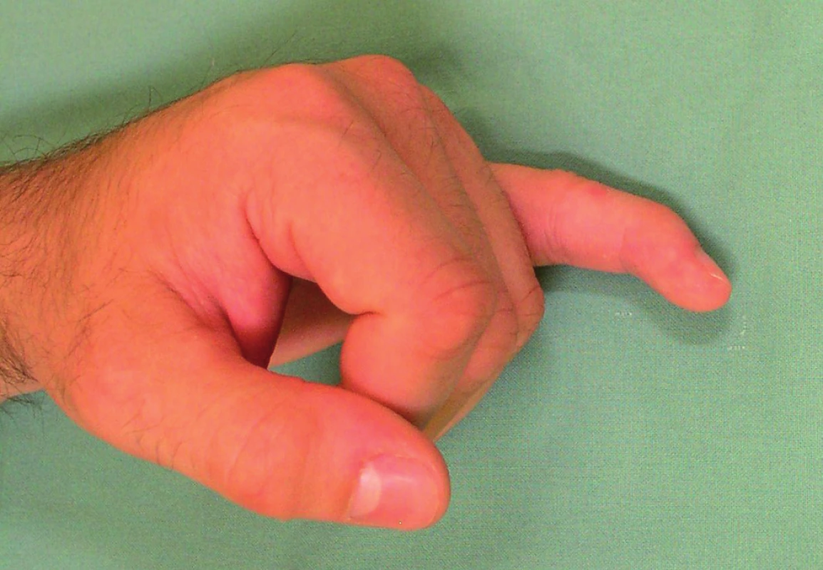 Typický klinický nález – semiflexe v distálním interfalangeálním kloubu.