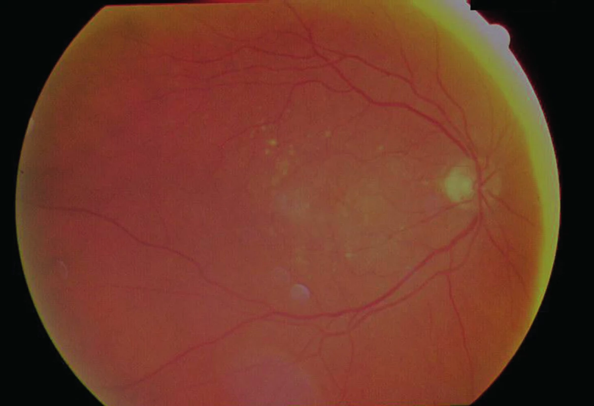 Farebný snímok fundu pravého oka. V makulárnej oblasti sú početné tvrdé i mäkké drúzy s edémom