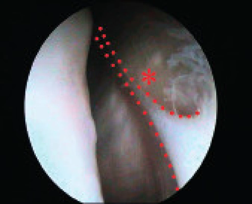 Artroskopický pohled na napjatou mediopatelární pliku – kontury pliky naznačeny.
Fig. 4. Arthroscopic view of the mediopatellar plica.