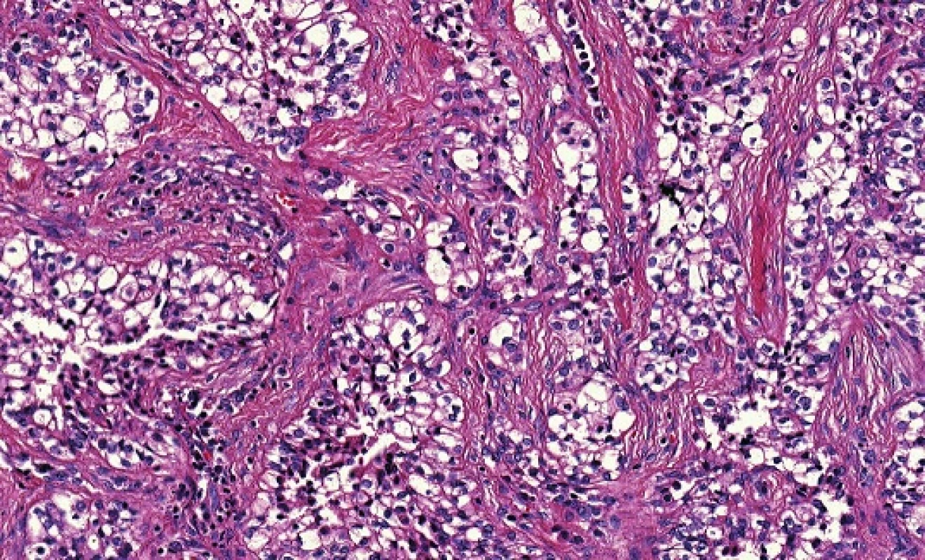 Hyalinizující světlobuněčný karcinom malých slinných žláz sestává z uniformních buněk s eosinofilní nebo vodojasnou cytoplasmou typicky uspořádaných do malých hnízd, pruhů a trabekulárních struktur, oddělených od sebe hyalinizovanými vazivovými septy. (hematoxylin-eozin).