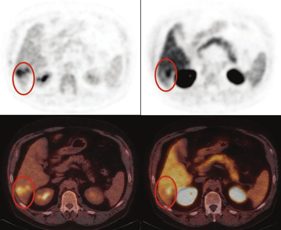 Zle diferencovaný hepatocelulárny karcinóm: časť nádoru pozitívna s FDG (A) a časť nádoru pozitívna s FCH (B). FDG pozitívne oblasti sa javia ako fotopenické v porovnaní s okolitým parenchýmom pečene pri PET/CT s FCH (B).