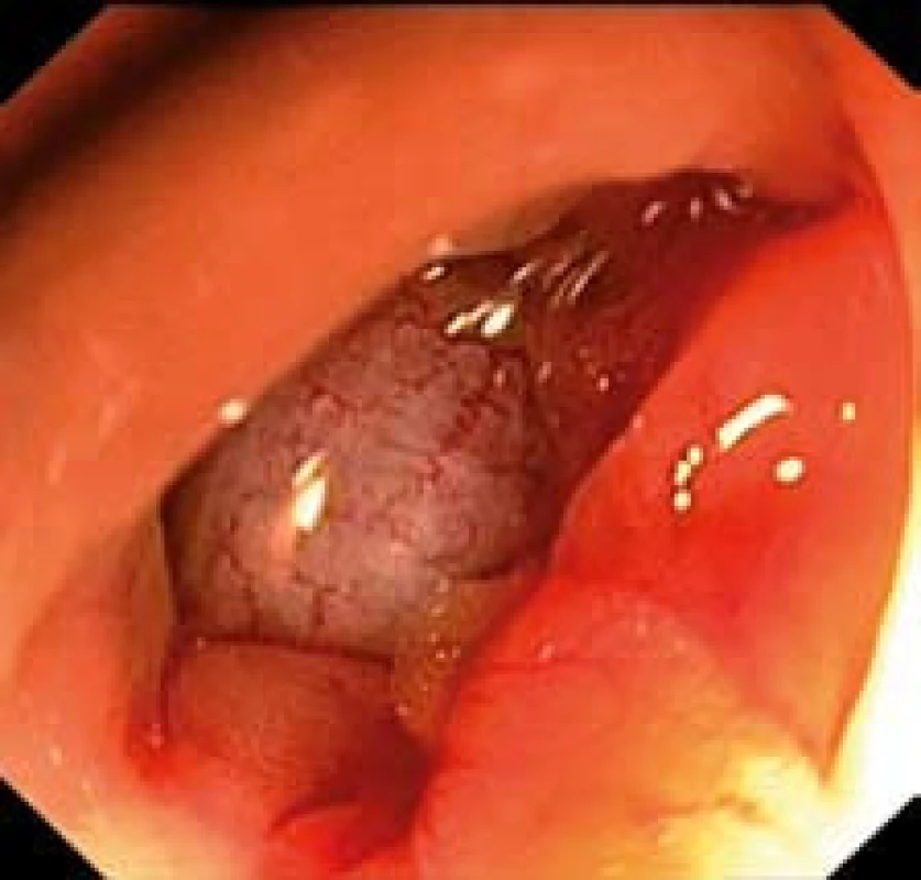 Velká perforace sigmatu, pohled do peritoneální dutiny.
Fig. 2. Large sigmoid colon perforation, view into the peritoneal cavity.