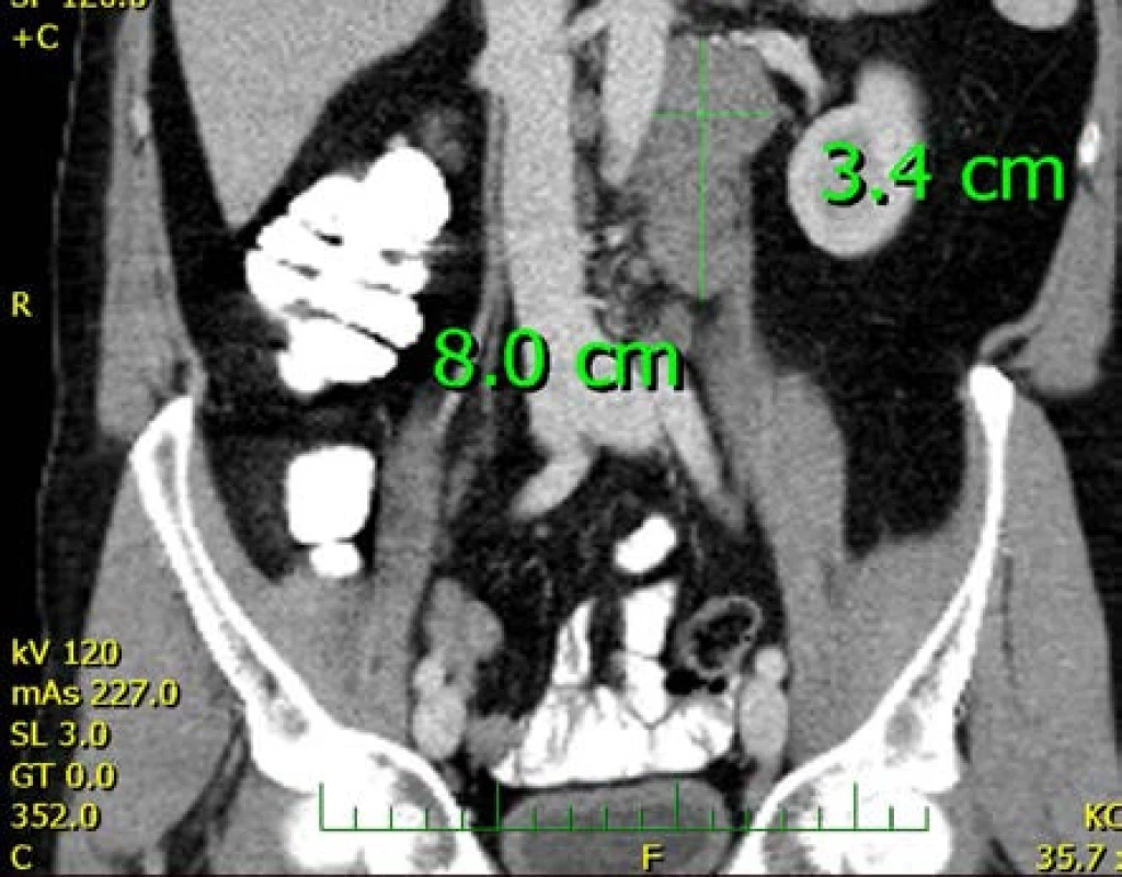 CT snímek s patrným paketem uzlin levého retroperitonea
Fig. 3. CT scan showing left retroperitoneal lymphadenopathy