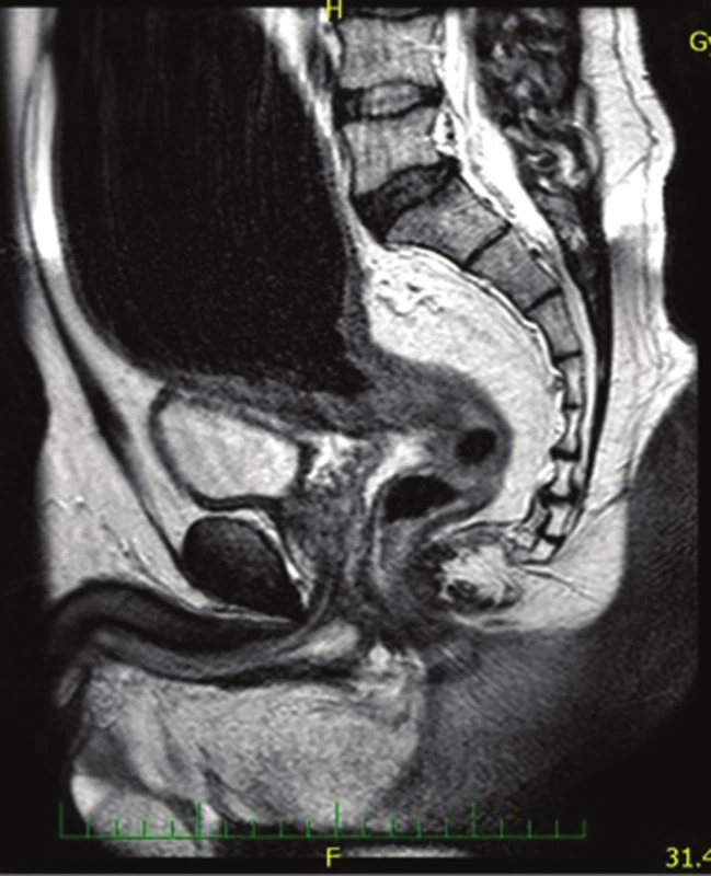 Magnetická rezonance u pacienta 1 s obrazem rektální formy H. ch.
Fig. 1: Magnetic resonance study showing a rectal form of HD in the first patient