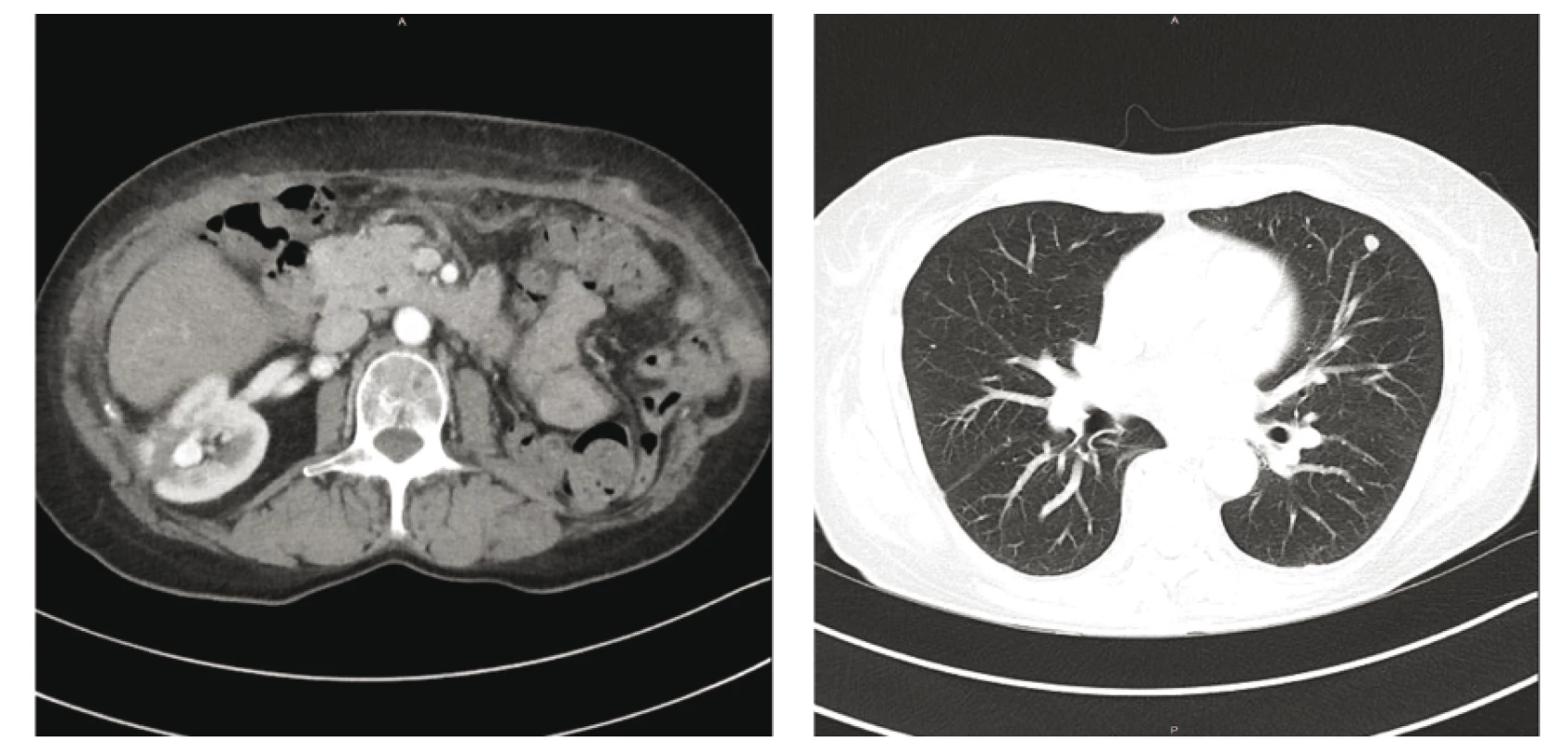 a 2: Restagingové CT po operaci: nové ložisko v místě po resekci tumoru vpravo,
meta ložisko v uzlině retrokaválně a progrese nádorového postižení plic