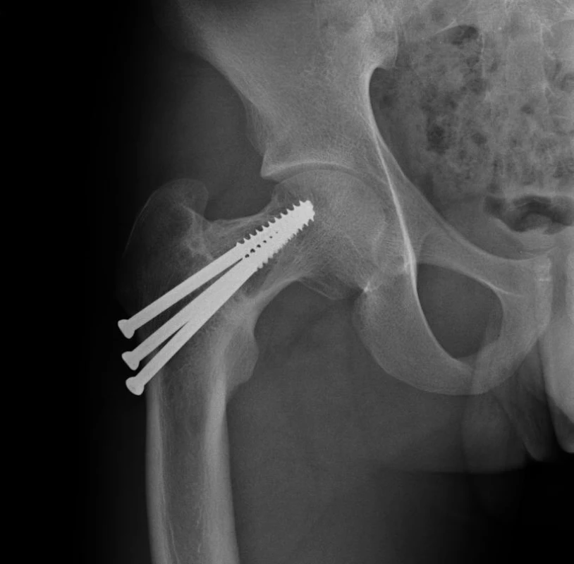 Prohojení zlomeniny Delbet II po osteosyntéze kanylovanými šrouby