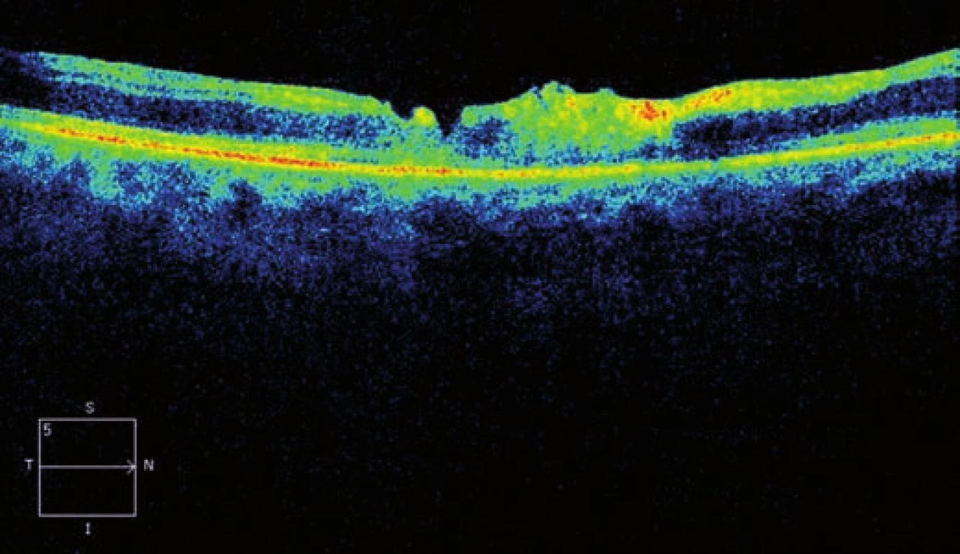Horizontální transfoveolární OCT sken, pooperační nález 2 měsíce po PPV