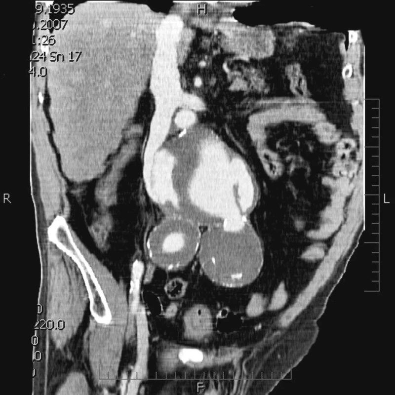CTA rekonstrukce velkého aneuryzmatu subrenální aorty a společných pánevních tepen s rupturou do dolní duté žíly.
Fig. 4. CTA recontruction of  the large subrenal aortic aneuysm and common pelvic arteries with a rupture into the inferior vena cava.
