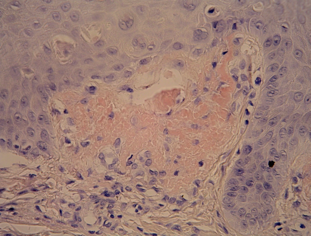 Detail dilatované dermální papily s amorfními globulemi přibarvujícími se konžskou červení, apoptotické keratinocyty v epidermis (Kongo červeň, zvětš.400x).
