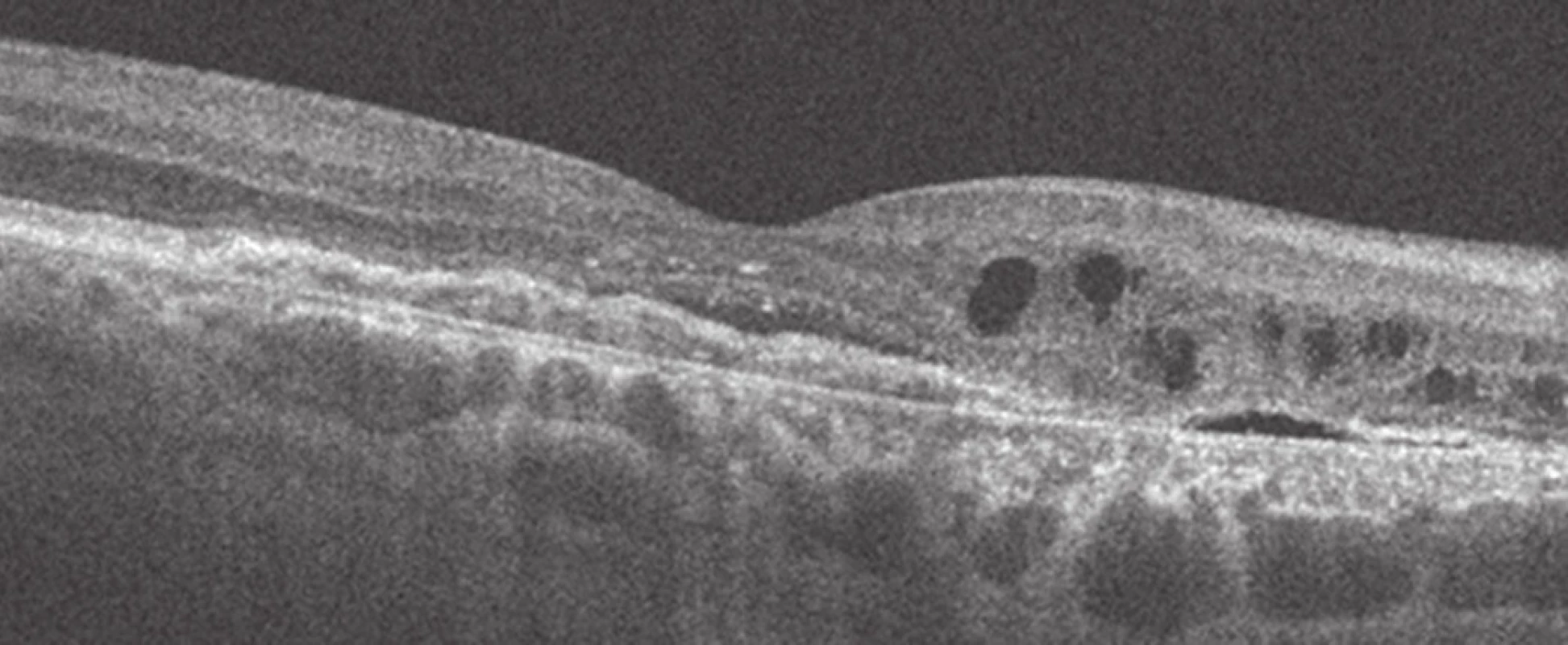 Zevní retinální tubulace (HD OCT Cirrus, Zeiss)