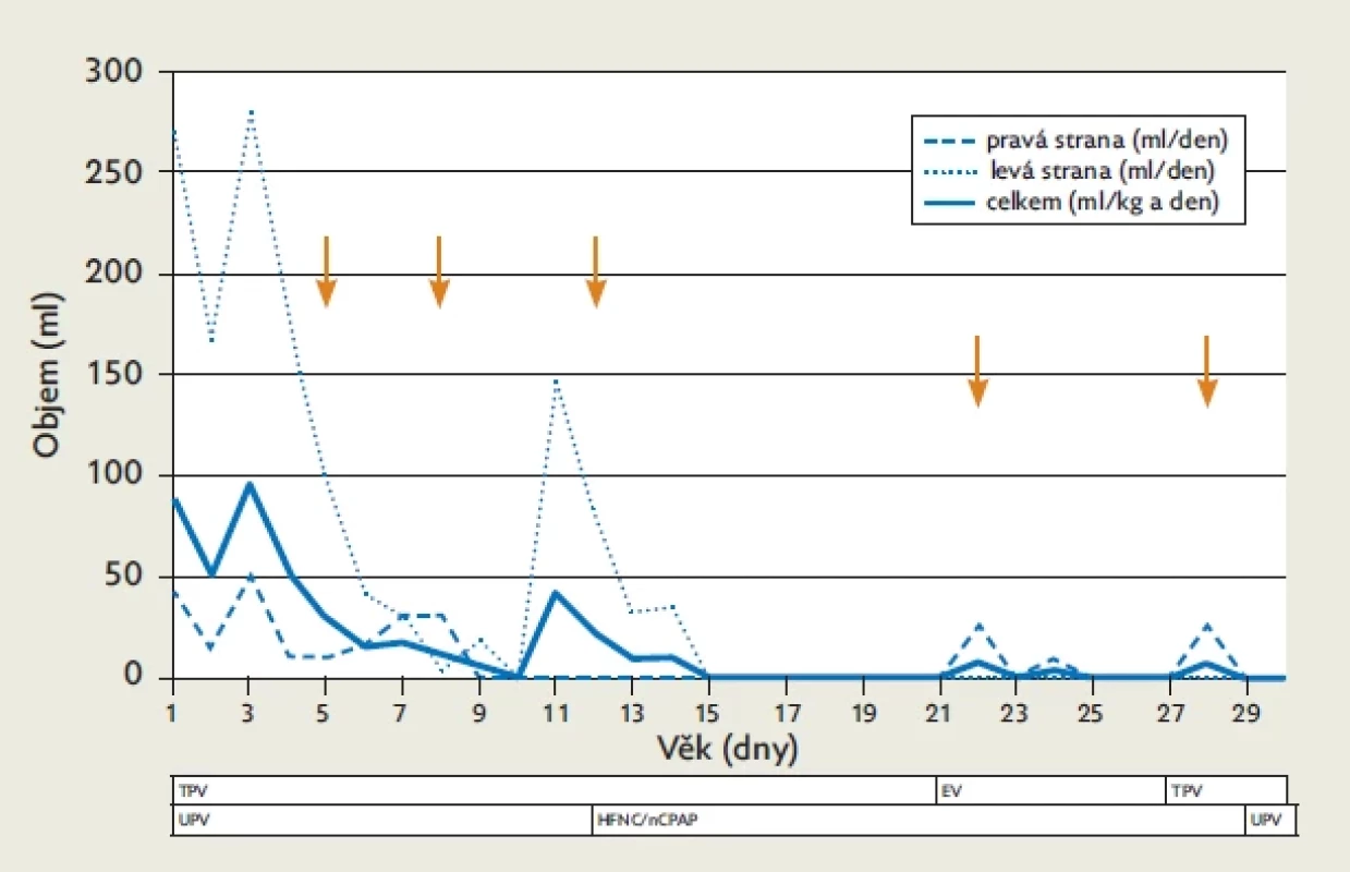 Denní množství chylu odváděného drény u pacienta z kazuistiky 2. Terapeutické intervence jsou vyznačeny v grafu či pod grafem, šipka značí podání chemické pleurodézy jodovaným povidonem.