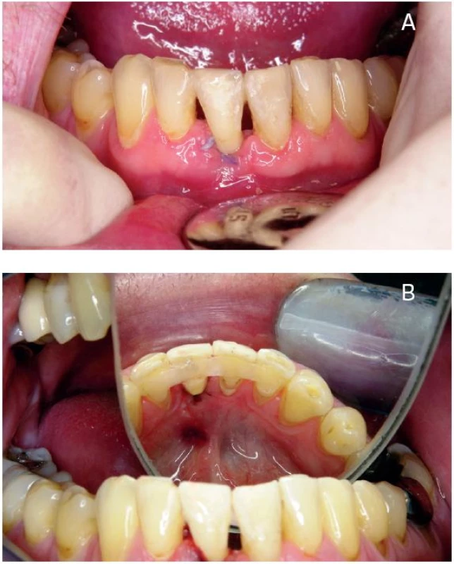 Adhezivní fixní můstek s náhradou dolního středního řezáku, zhotovený imediátně a přímou technikou s využitím extrahovaného zubu pacienta – pohled ze strany vestibulární (a) a ze strany lingvální (b); foto autorka