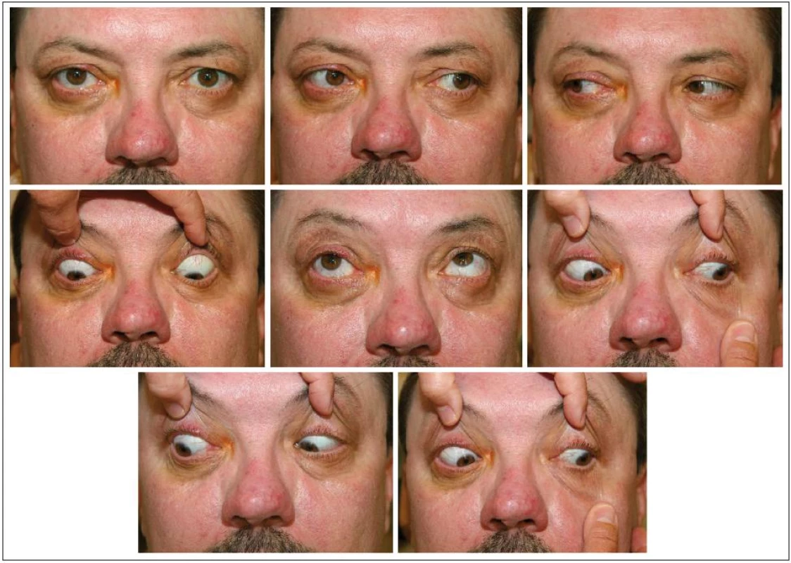Oční motilita tři týdny pooperačně – mírné omezení jen při pohledu vpravo nahoru.
