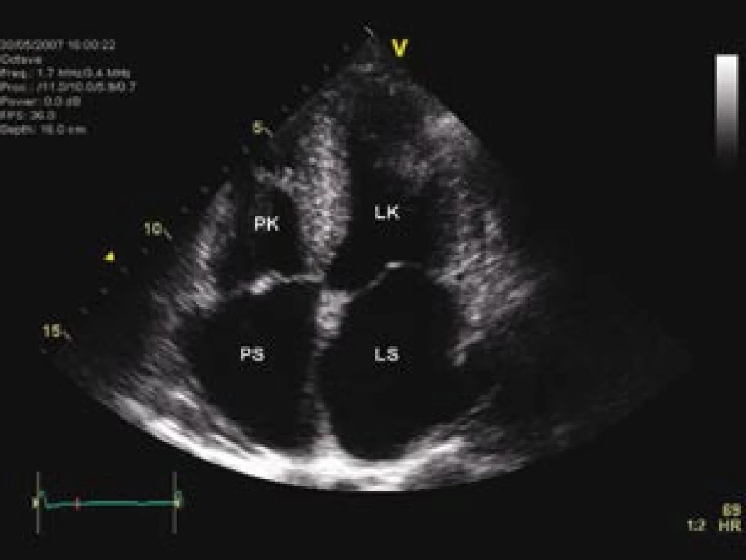 Echokardiografický obraz difuzně hypertrofické nezvětšené levé komory a dilatace obou srdečních síní.