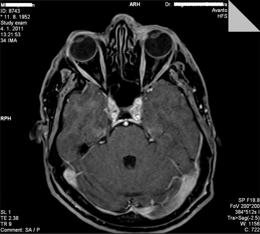 MRI vyšetrenie orbity u pacienta s infiltráciou mediálneho kútika ľavého oka pred HDR brachyterapiou