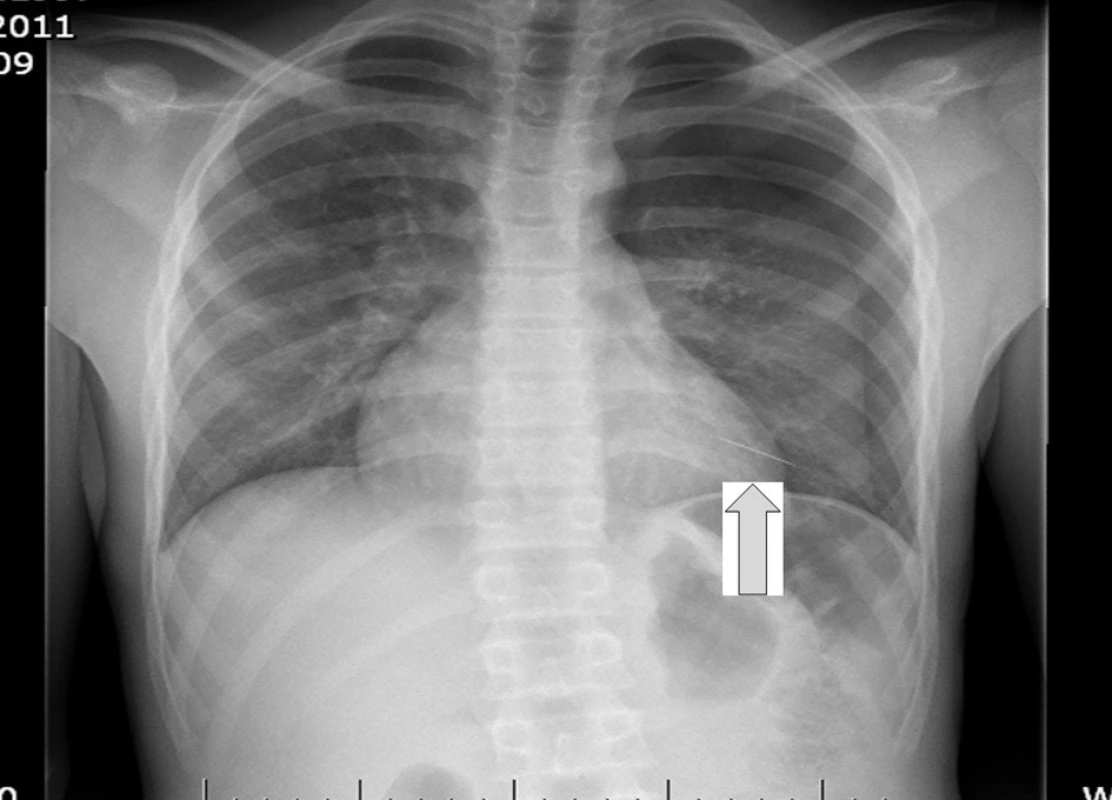 Cizí těleso charakteru jehly se promítá do dolního plicního pole vlevo, mezi dorsálním průběhem 9. a 10. žebra. Je patrný pneumotorax vlevo, oddálení apexu plíce je 50 mm, laterálně 15 mm
Fig. 6: Foreign object in the shape of a needle, projecting to the lower left lung region, between the dorsal course of the 9th and 10th rib. Left pneumothorax visible, the displacement of the lung apex is 50 mm, lateral 15 mm
