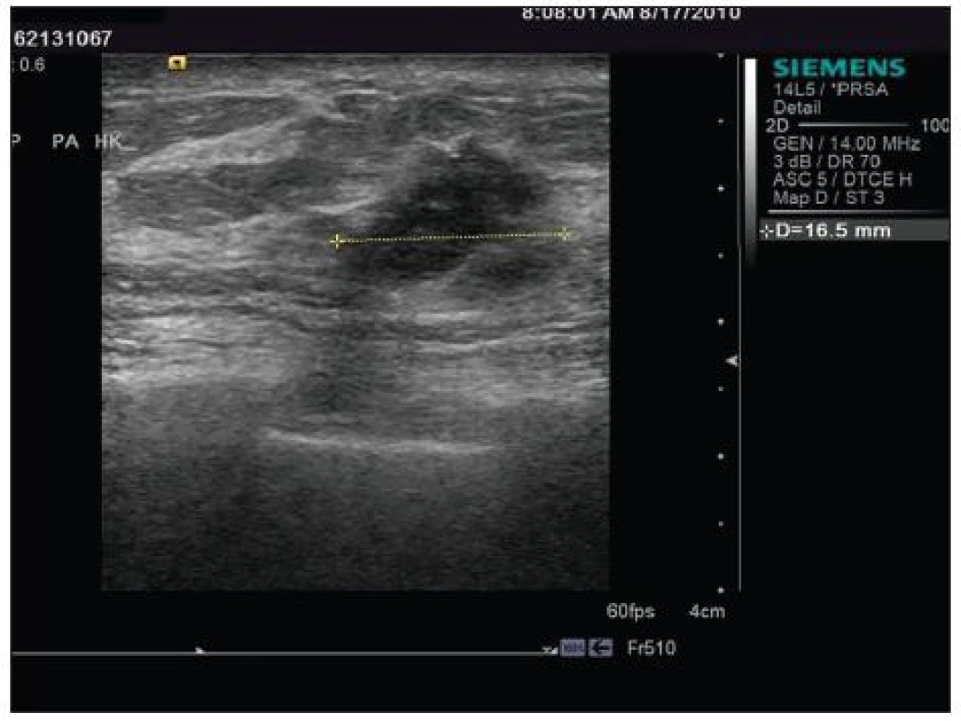 Sonografie pravého prsu
Fig. 11. Sonograpphy of the right breast