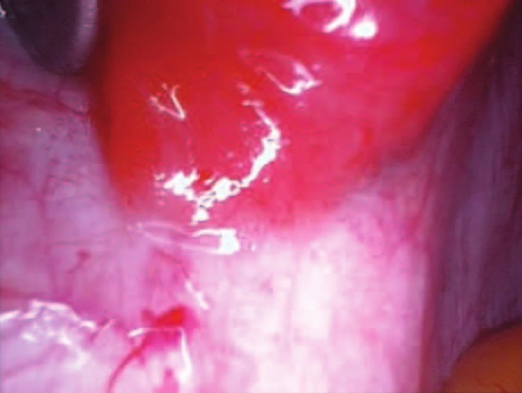 Ložisko abdominální gravidity ve fossa ovarica vlevo.