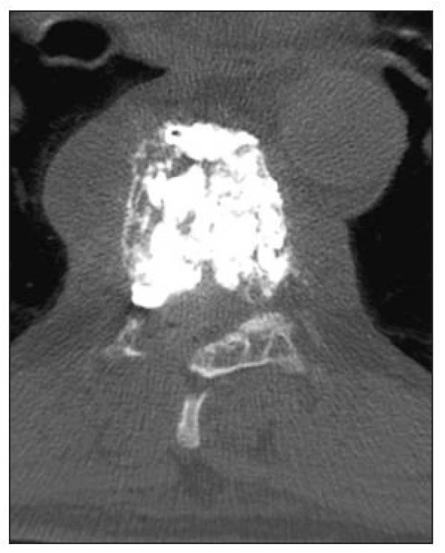 CT axiální sken obratle Th7 po vertebroplastice
Fig. 3. CT axial scan of TH7 following vertebroplasty