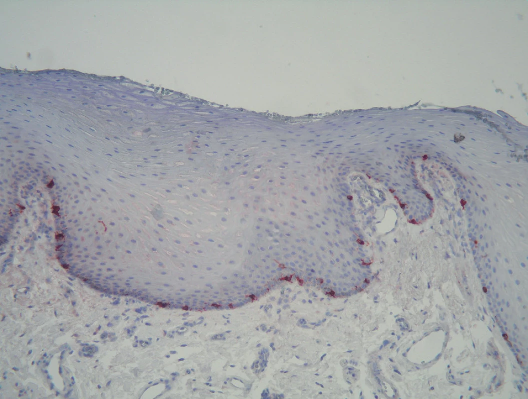 Orálna melanotická makula – detekcia melanocytov (markerMelan-A, IPx, 200x).