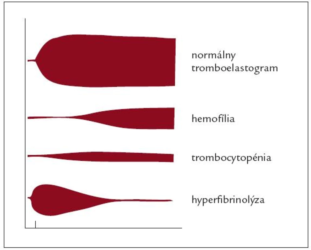 Náčrt normálneho tromboelastogramu a niektorých typických porúch koagulácie zachytených pri TEG (zdroj – obrazové materiály firmy Biovendor).