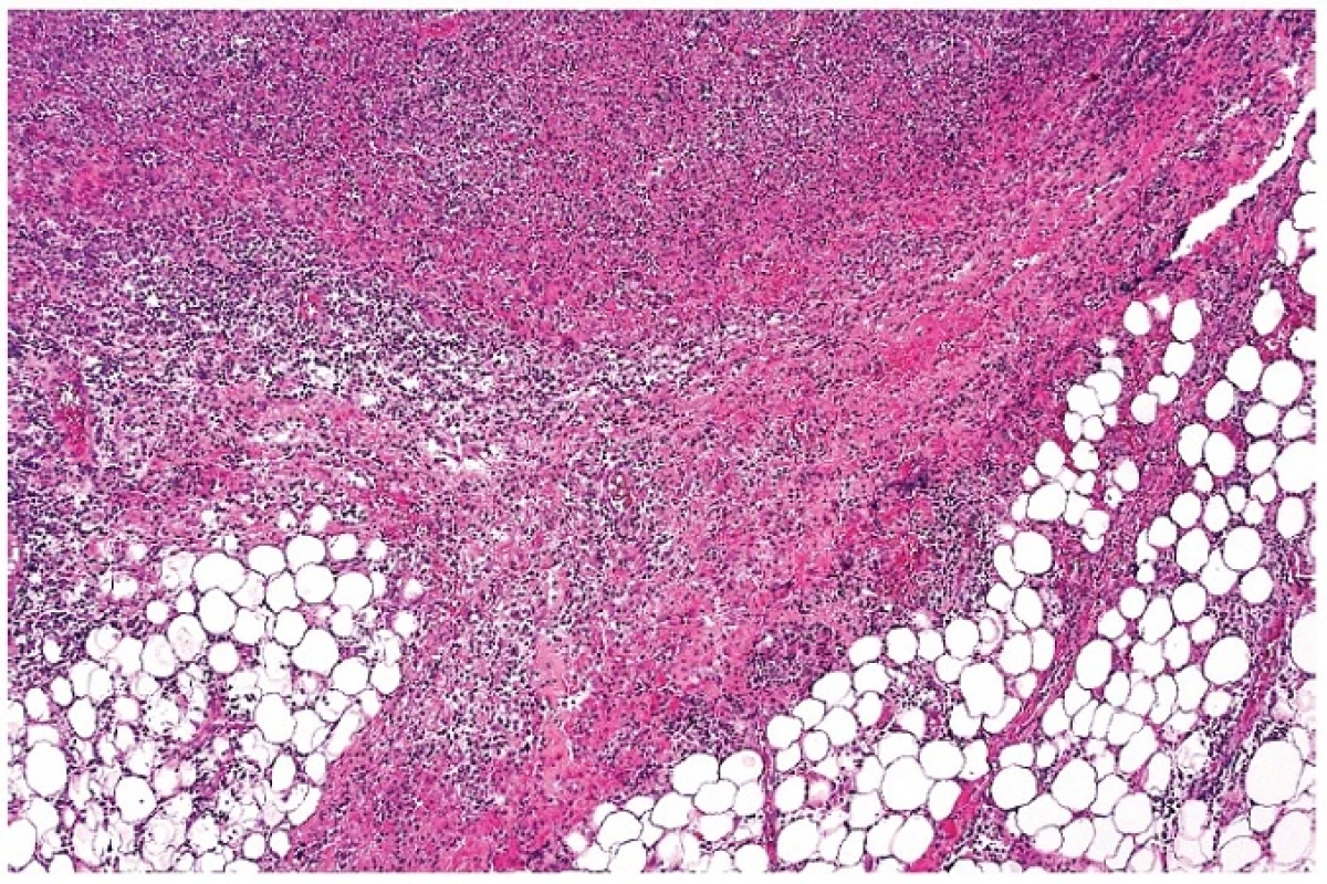 Zánětlivá fibroproduktivní reakce paprsčitě vyzařující za hranici původního pouzdra lymfatické uzliny s bohatou lymfocytární příměsí. Oblasti souvisejí s nekrotickým úsekem v uzlině (částečně zachycen v horní části obrázku). Barveno hematoxylinem a eozinem (zvětšení 50x).