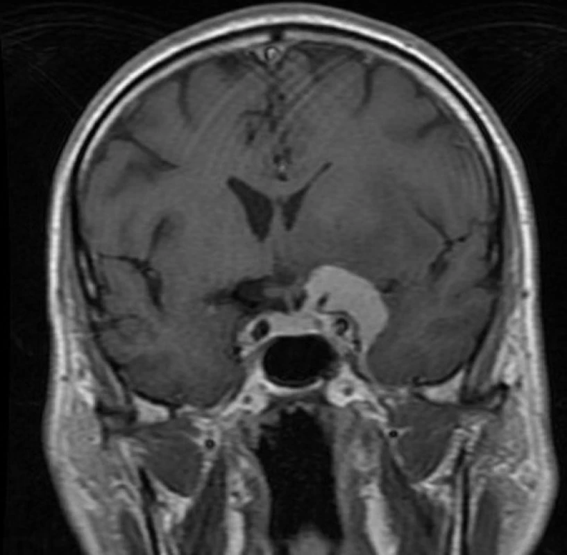 MRI prokazující meningiom (vnitřní varianta křídla kosti klínové)
Fig. 1: MRI disclosing sphenoid wing meningioma